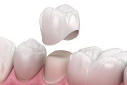 Preparated,Premolar,Tooth,And,Dental,Crown,Placement.,Medically,Accurate,3d